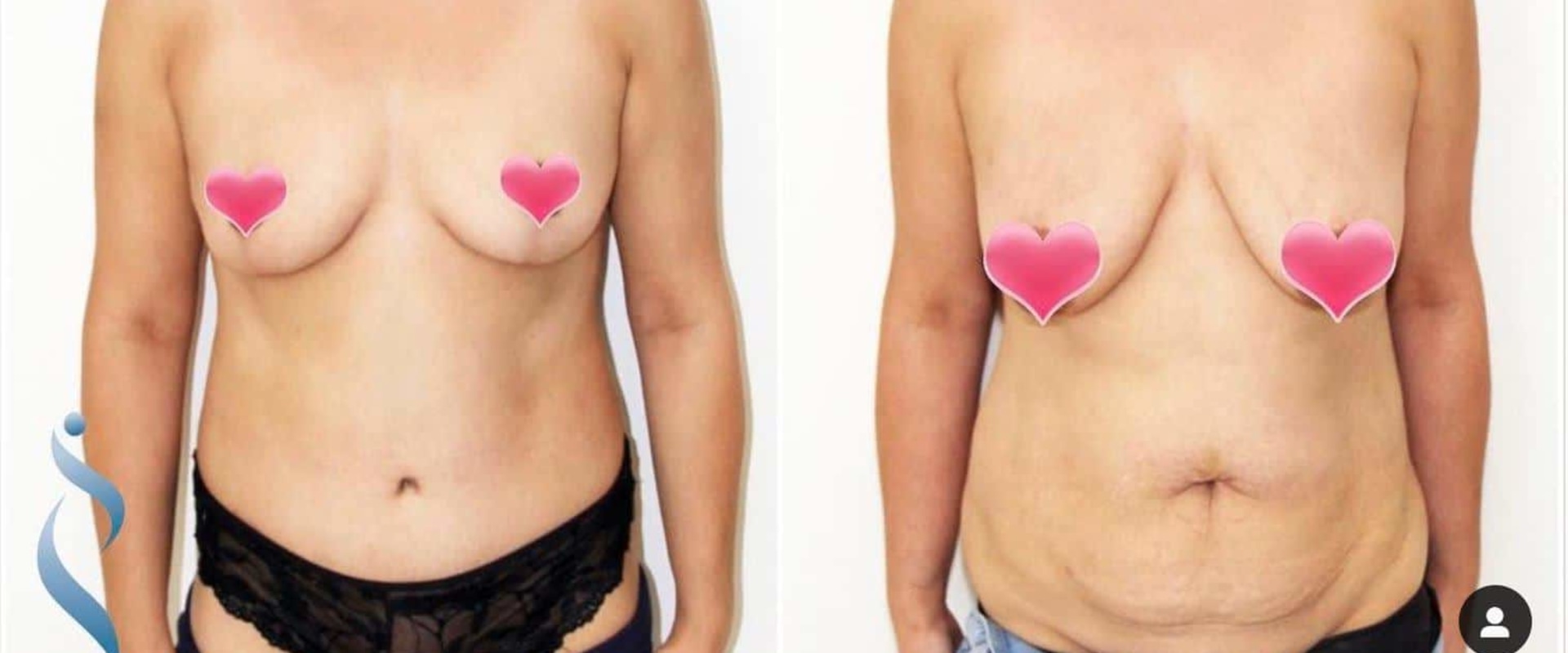 A Complete Guide to Tummy Tuck Costs