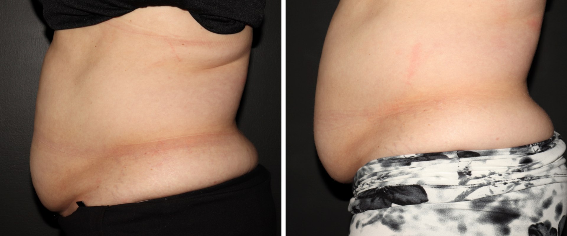 All You Need to Know About truSculpt for Non-Invasive Body Contouring