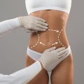 Long-lasting Results: Achieving Your Desired Body Shape Through Surgical Body Contouring