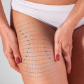 Thigh Lift: Enhancing Your Appearance with Surgical Body Contouring