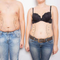 Understanding Asymmetry in Body Contouring