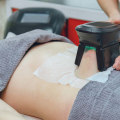 Exploring Cryolipolysis for Non-Invasive Body Contouring