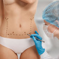 Pre-surgery Instructions for Body Contouring Procedures