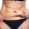 A Complete Guide to Tummy Tuck Procedures