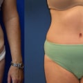 Post-Surgery Care for Achieving Your Desired Body Shape