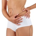 All You Need to Know About Liposuction