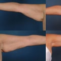 Arm Lift: Achieving Your Desired Body Shape