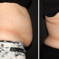 All You Need to Know About truSculpt for Non-Invasive Body Contouring