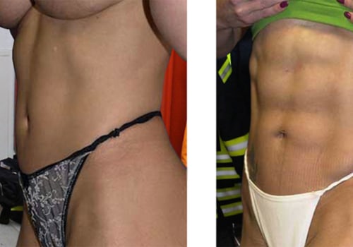 Liposuction: A Guide to Body Contouring Costs