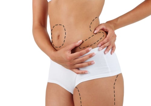 All You Need to Know About Liposuction