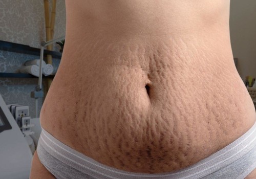 A Comprehensive Look at Laser Lipolysis for Body Contouring