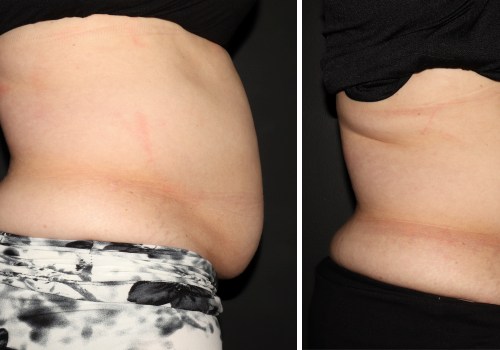 All You Need to Know About truSculpt for Non-Invasive Body Contouring